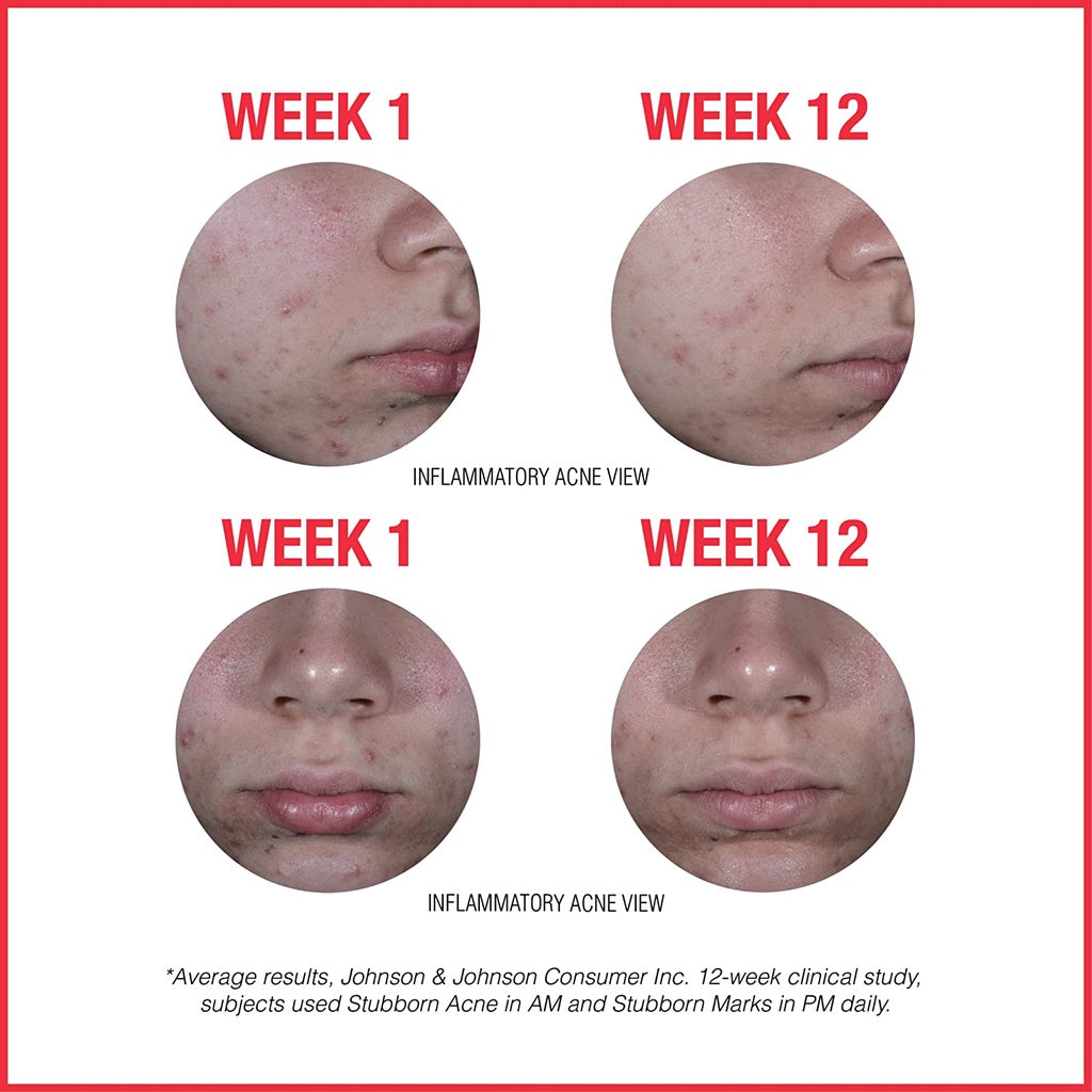 Low Cost PH | Neutrogena, Stubborn Acne AM PM Treatment, Benzoyl Peroxide De La Cruz Ance Treatment.