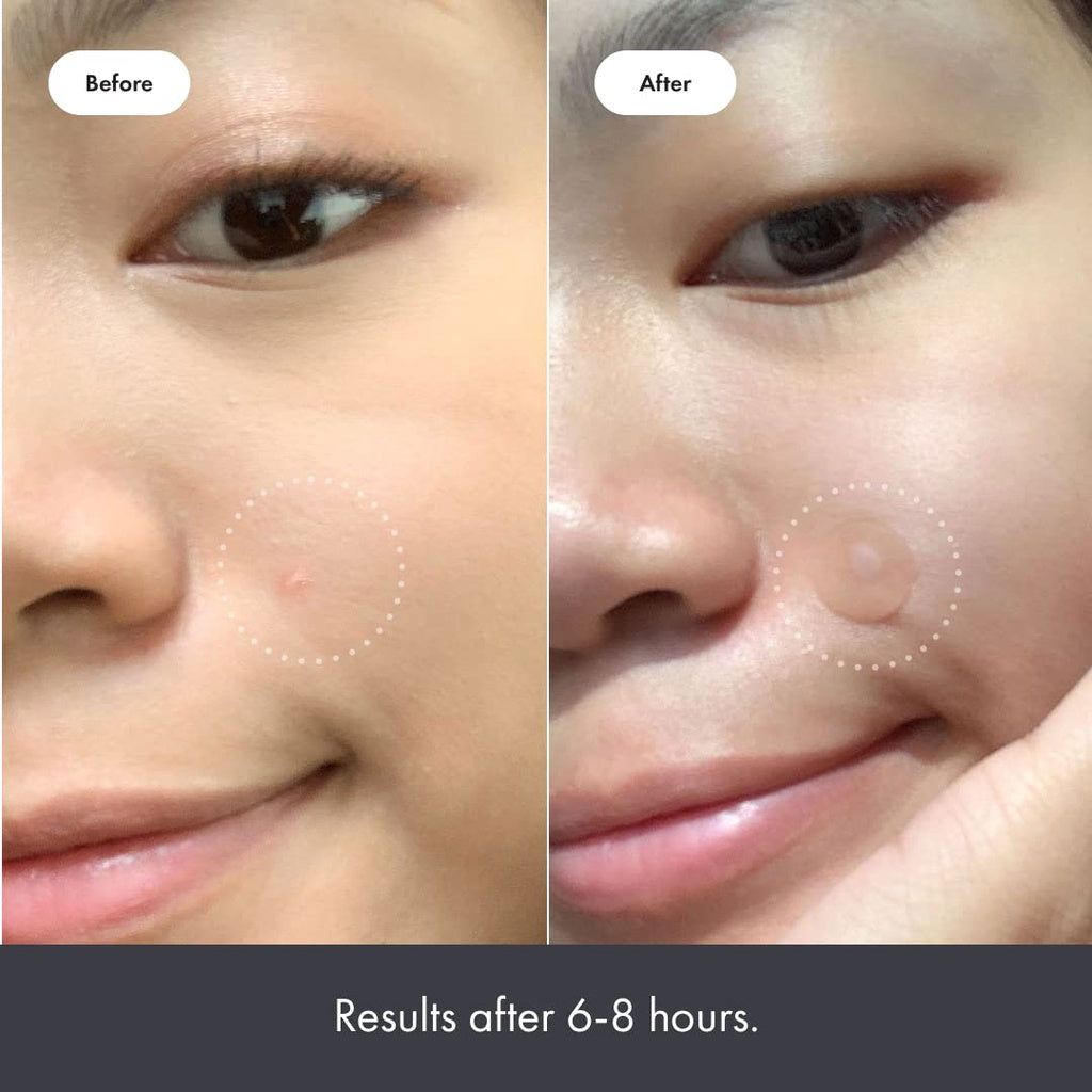 Low Cost PH | Cosrx, Acne Pimple Master / Hero Cosmetic Mighty Patch / De La Cruz Treatment Ointment